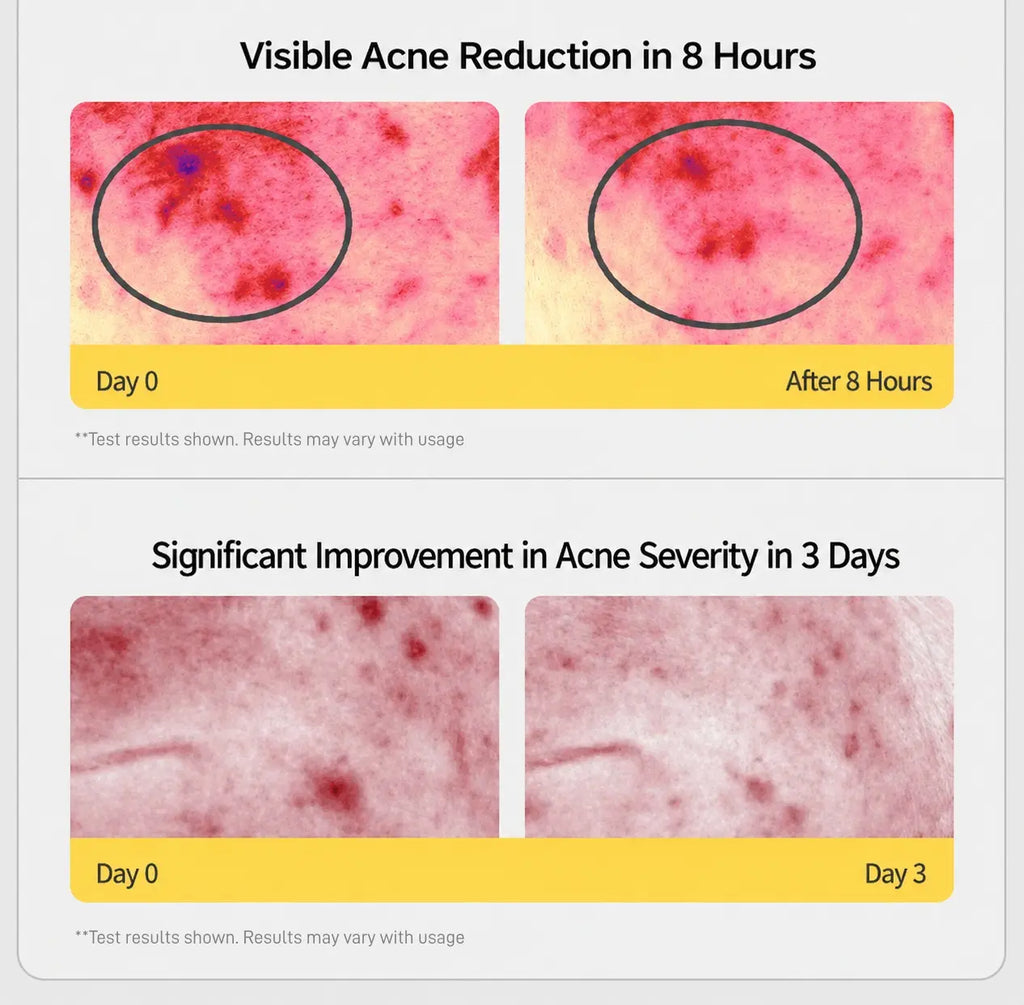 Colloidal Sulfur Multi-Peptide Serum | Skin Treatment & Acne Treatment | 8H Acne Relief&7D Skin Repair,Oat Soothing Redness Relief Essence, Oil Control Acne Clearing Anti-Aging Hydrating Skin Repair Serum for Sensitive Oily Skin